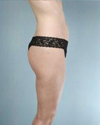 Liposuction Before and After Pictures Houston, TX