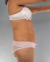 Liposuction Before and After Pictures Houston, TX