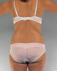 Liposuction Before and After Pictures Houston, TX