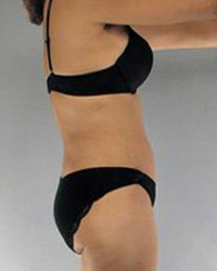 Liposuction Before and After Pictures Houston, TX