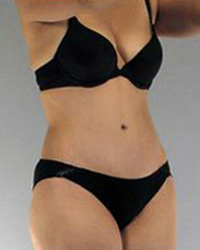 Liposuction Before and After Pictures Houston, TX