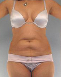 Liposuction Before and After Pictures Houston, TX