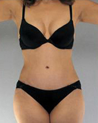 Liposuction Before and After Pictures Houston, TX