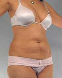 Liposuction Before and After Pictures Houston, TX