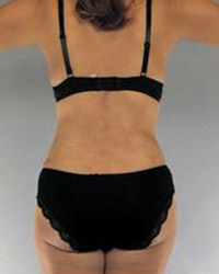 Liposuction Before and After Pictures Houston, TX