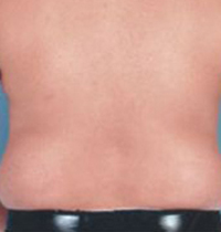 Liposuction Before and After Pictures Houston, TX