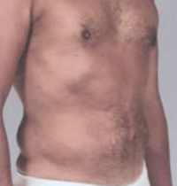 Liposuction Before and After Pictures Houston, TX