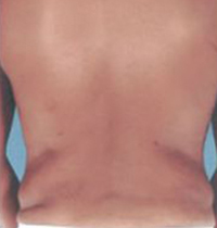 Liposuction Before and After Pictures Houston, TX