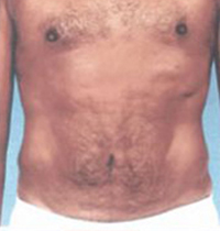 Liposuction Before and After Pictures Houston, TX