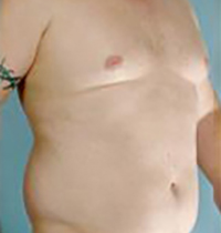 Liposuction Before and After Pictures Houston, TX