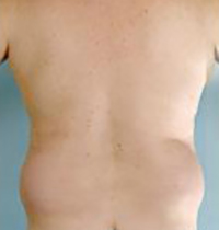 Liposuction Before and After Pictures Houston, TX