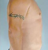 Liposuction Before and After Pictures Houston, TX