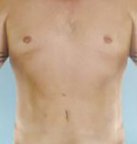 Liposuction Before and After Pictures Houston, TX