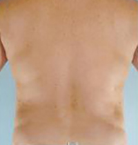 Liposuction Before and After Pictures Houston, TX