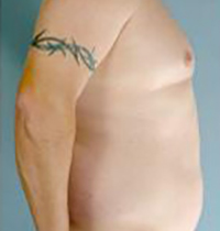 Liposuction Before and After Pictures Houston, TX