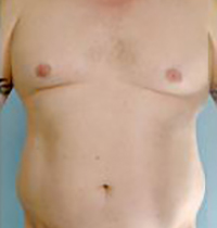 Liposuction Before and After Pictures Houston, TX