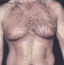 Gynecomastia Before and After Pictures Houston, TX