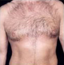 Gynecomastia Before and After Pictures Houston, TX