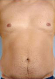 Abdominal Etching Before and After Pictures Houston, TX