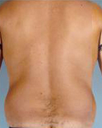 Abdominal Etching Before and After Pictures Houston, TX