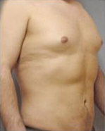 Abdominal Etching Before and After Pictures Houston, TX