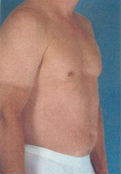 Abdominal Etching Before and After Pictures Houston, TX