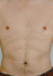 Abdominal Etching Before and After Pictures Houston, TX