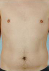 Abdominal Etching Before and After Pictures Houston, TX