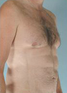 Abdominal Etching Before and After Pictures Houston, TX