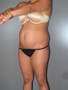 Tummy Tuck Before and After Pictures Houston, TX