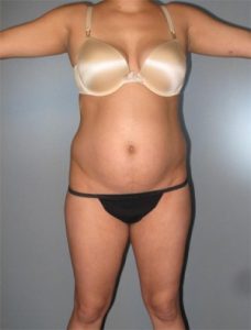 Tummy Tuck Before and After Pictures Houston, TX