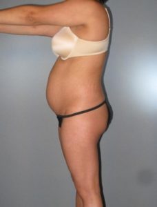 Tummy Tuck Before and After Pictures Houston, TX