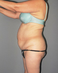 Liposuction Before and After Pictures Houston, TX