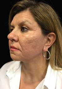 INFINI™ Skin Tightening Before and After Pictures Houston, TX