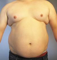 Liposuction Before and After Pictures Houston, TX