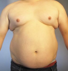 Tummy Tuck Before and After Pictures Houston, TX