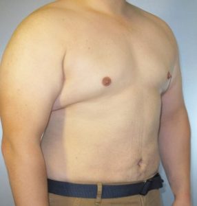 Tummy Tuck Before and After Pictures Houston, TX