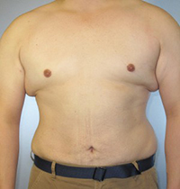 Liposuction Before and After Pictures Houston, TX