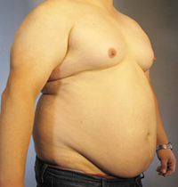 Liposuction Before and After Pictures Houston, TX