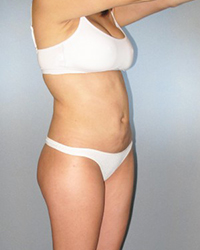 Liposuction Before and After Pictures Houston, TX