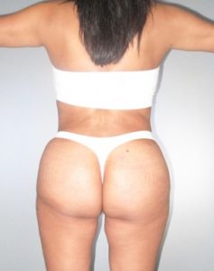 Brazilian Butt Lift Before and After Pictures Houston, TX