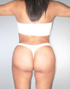 Brazilian Butt Lift Before and After Pictures Houston, TX