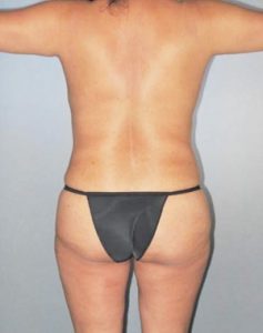 Brazilian Butt Lift Before and After Pictures Houston, TX