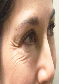 INFINI™ Skin Tightening Before and After Pictures Houston, TX