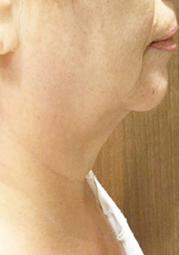 INFINI™ Skin Tightening Before and After Pictures Houston, TX