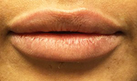 Lip Injections Before and After Pictures Houston, TX