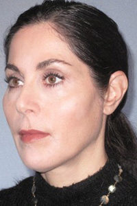Dermal Fillers Before and After Pictures Houston, TX