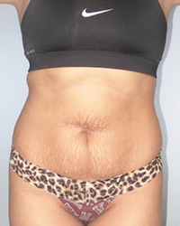 Liposuction Before and After Pictures Houston, TX