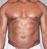 Liposuction Before and After Pictures Houston, TX