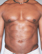 Abdominal Etching Before and After Pictures Houston, TX